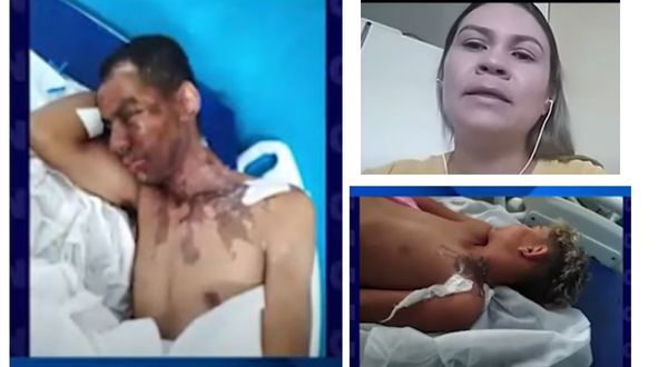 Pai e filho têm corpos queimados por ácido jogado por agressor que o ameça desde sua separação conjugal